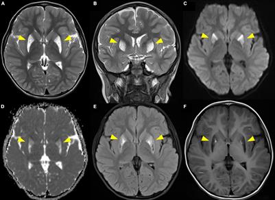 NDUFAF6-Related Leigh Syndrome Caused by Rare Pathogenic Variants: A Case Report and the Focused Review of Literature